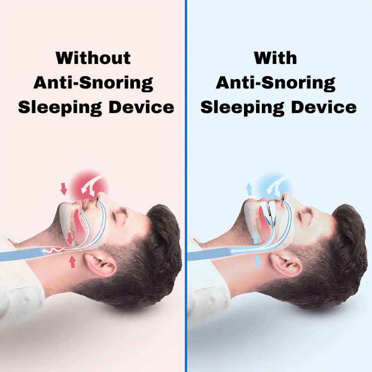 Anti-snoring Sleeping Aid